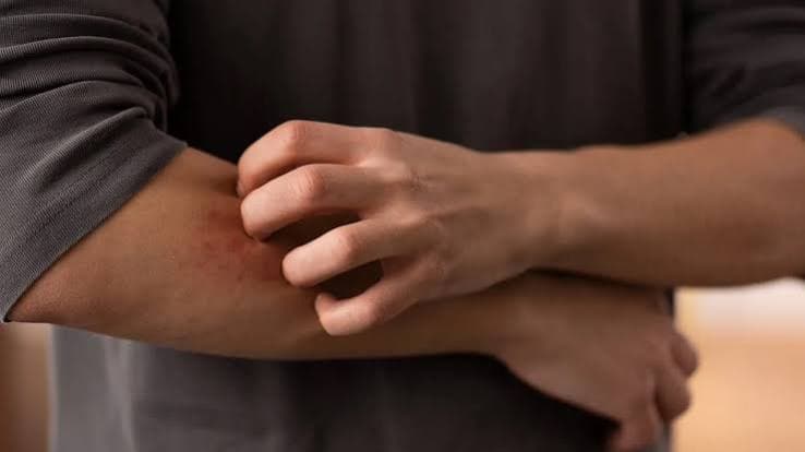 Aumento dei casi di dermatofilosi in Europa. Pregliasco: «Rischio contenuto, ma le modalità di trasmissione stanno evolvendo»